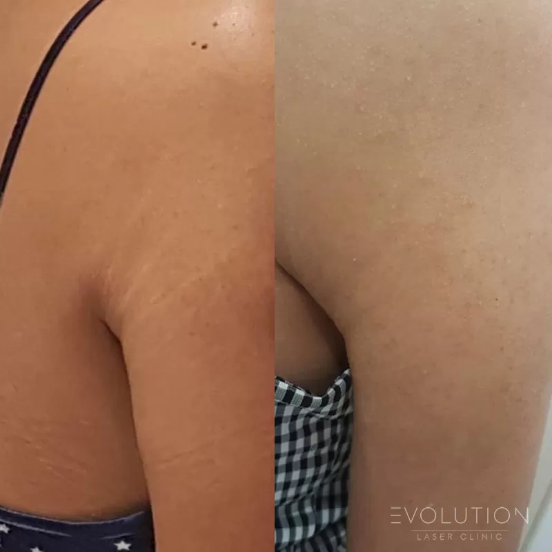 Stretchmark & Scar Reduction