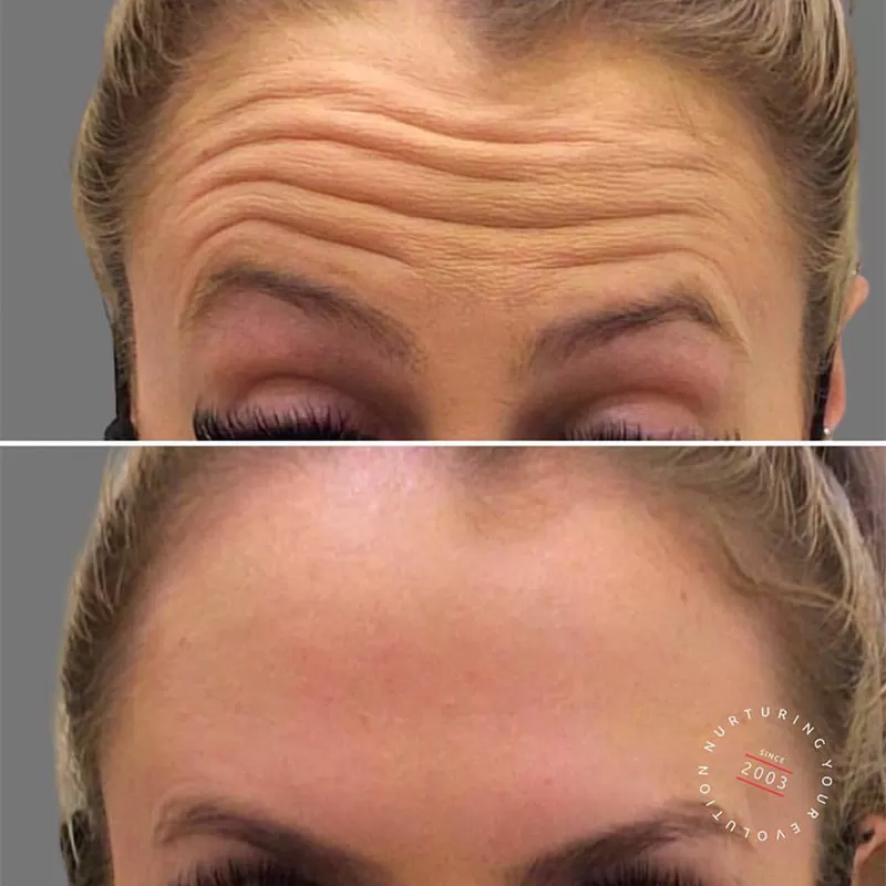 Anti-Wrinkle Injections