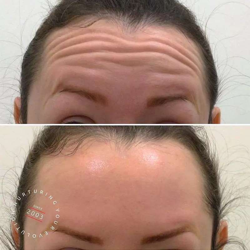 Anti-Wrinkle Injections