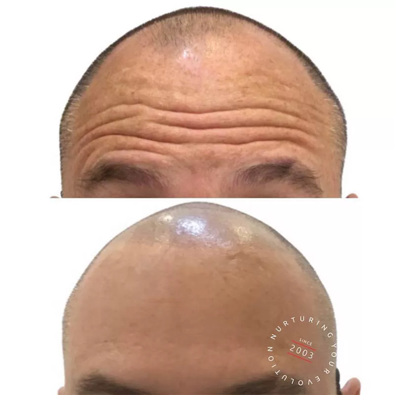 Anti-Wrinkle Injections