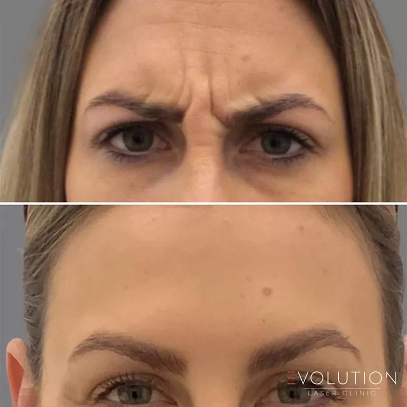 Anti-Wrinkle Injections