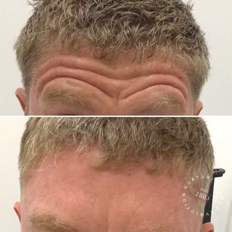 Anti-Wrinkle Injections