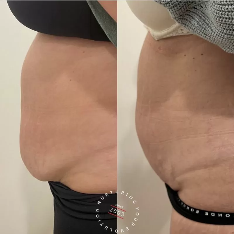 Fat Reduction