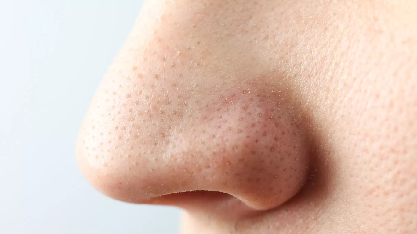 3 Professional Treatments to Help Remove Blackheads