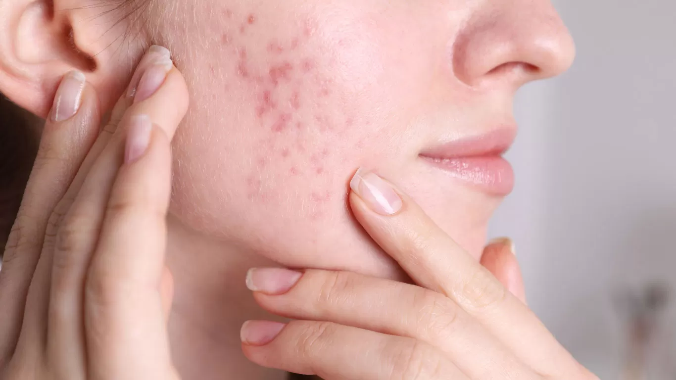 How LED Light Therapy Helps with Acne & Skin Healing