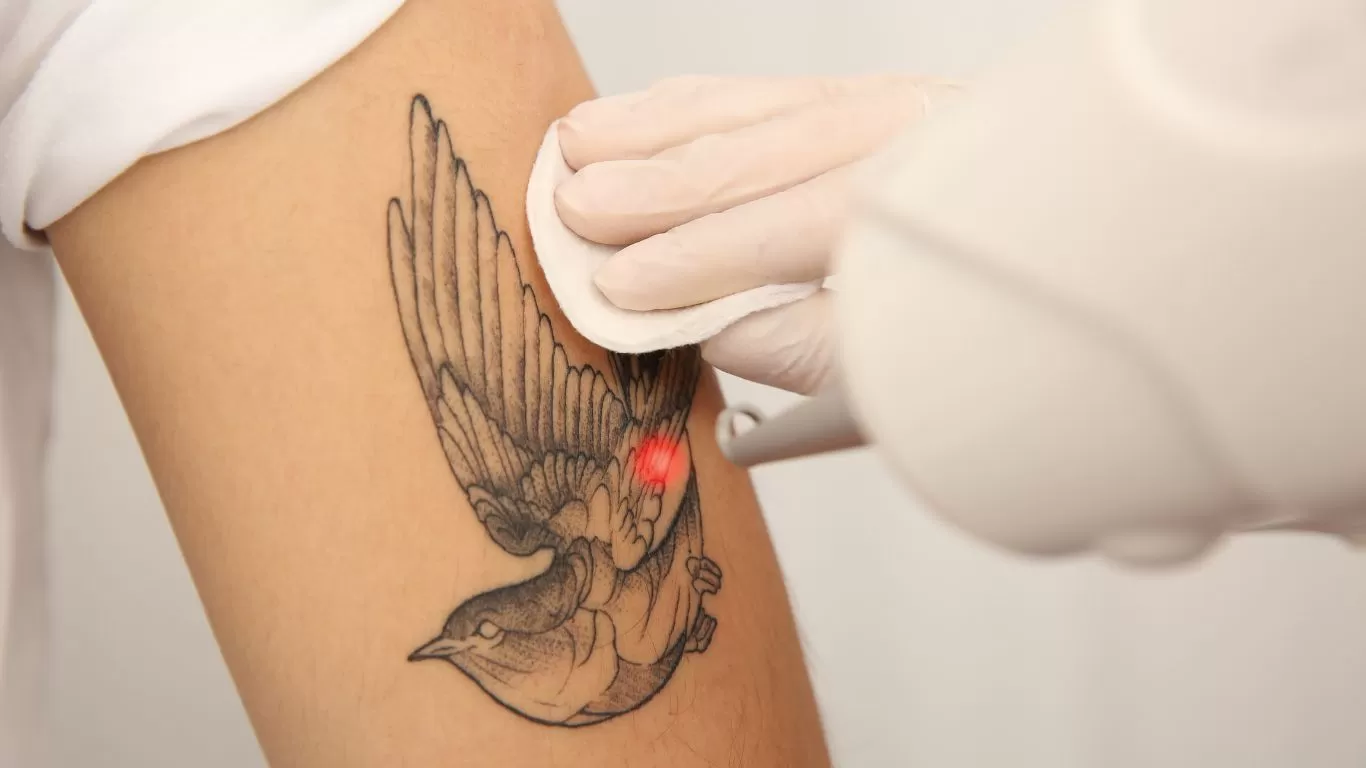 A gloved hand holds gauze on a person's arm while a laser device targets a bird tattoo, indicating a tattoo removal procedure.