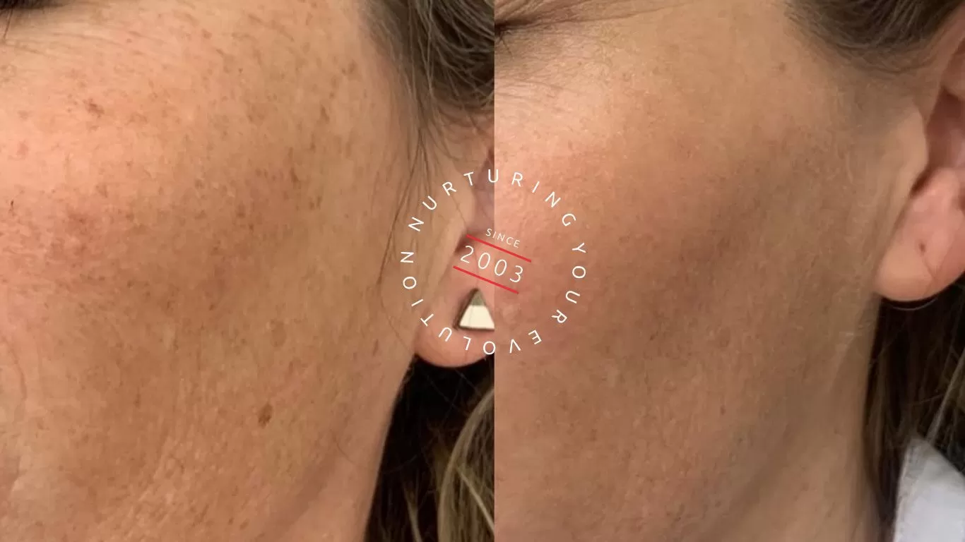 Inside Our Technology: How Candela Powers Your Laser Treatments