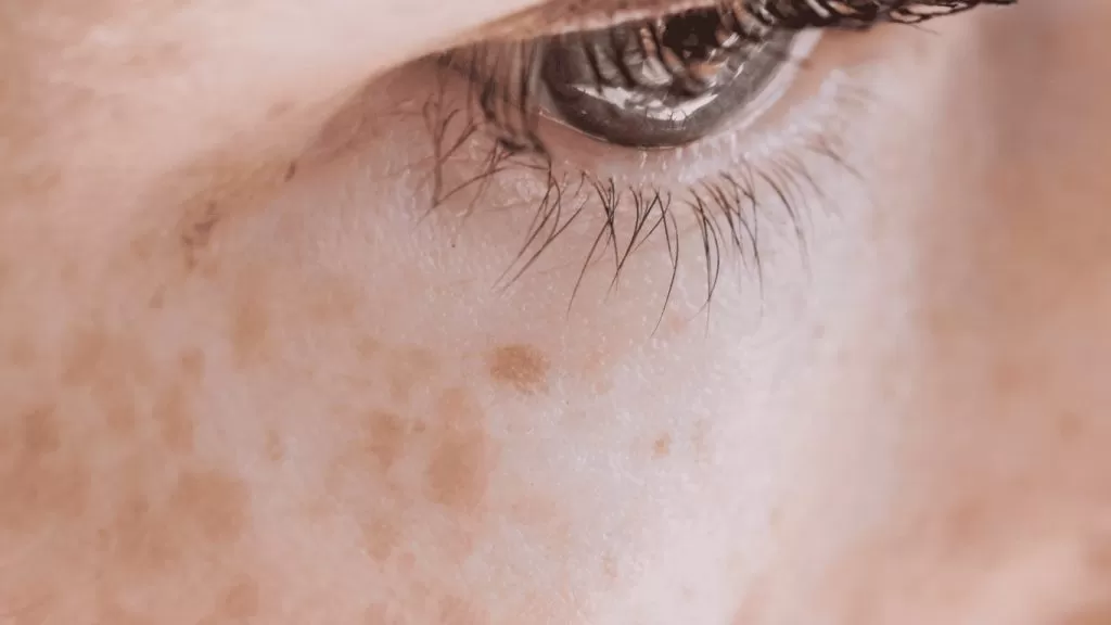 How to Treat Pigmentation and Texture Changes