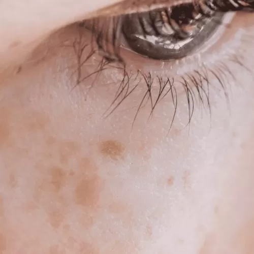 How to Treat Pigmentation and Texture Changes