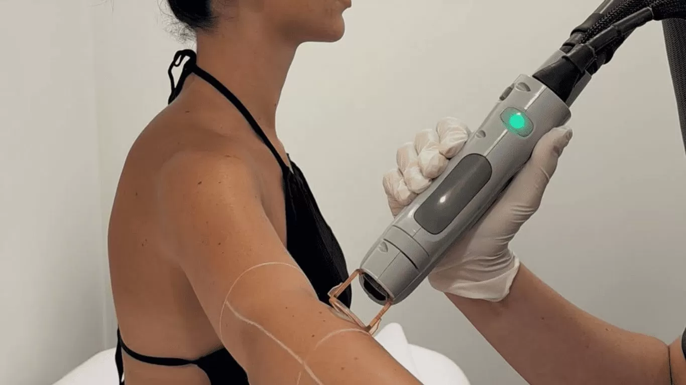 Why Multiple Laser Hair Removal Sessions Are Needed