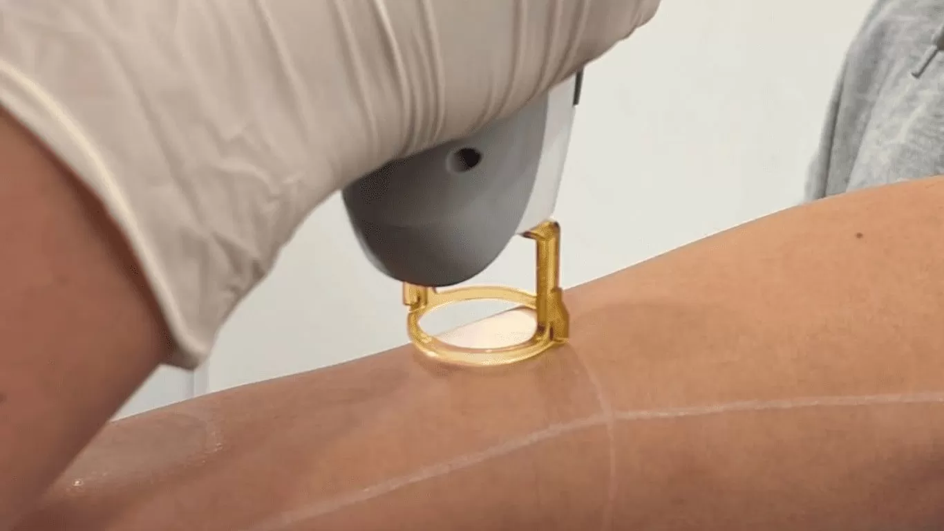 When Will You See Permanent Results?